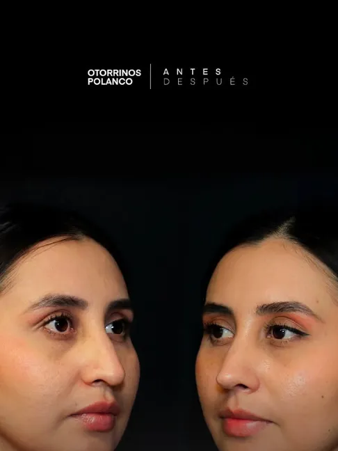 Antes y Después Rinoplastia 4