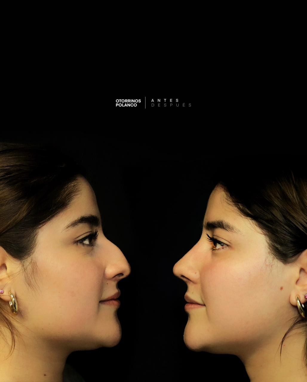 Antes y Después Rinoplastia 2