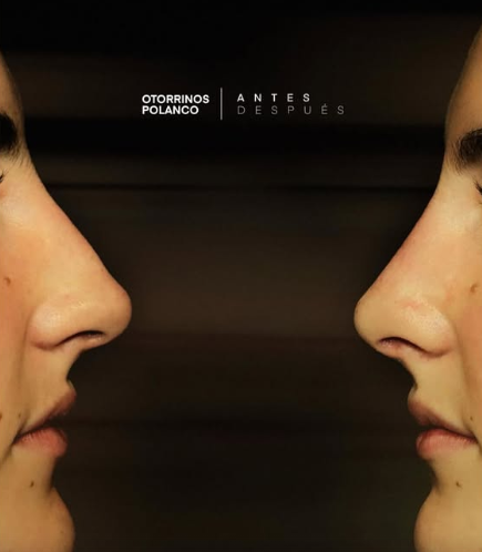Antes y Después Rinoplastia 3