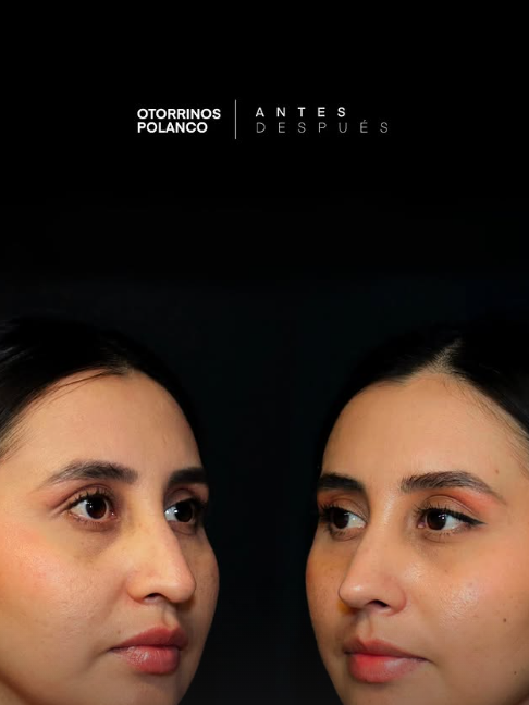 Antes y Después Rinoplastia 4