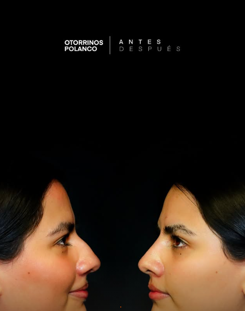 Antes y Después Rinoplastia 5