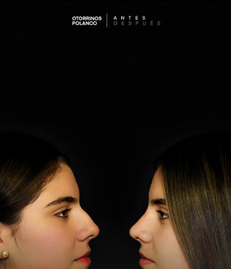 Antes y Después Rinoplastia 6