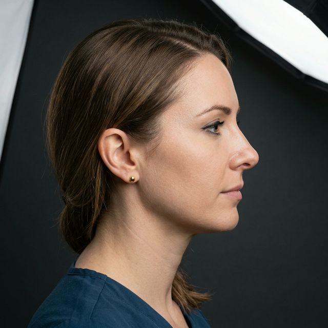 Resultado rinoplastia 2