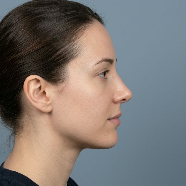 Después del procedimiento